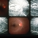 Choroiditis Choroiditis